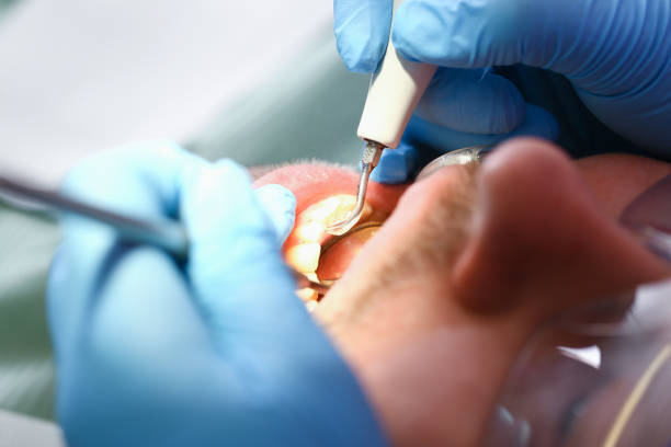 Best Emergency Dental Care for Broken or Chipped Teeth in Dunlap, IA